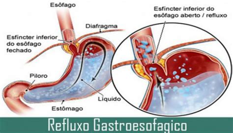 Refluxo E Alimentação - Refluxo Gastrico