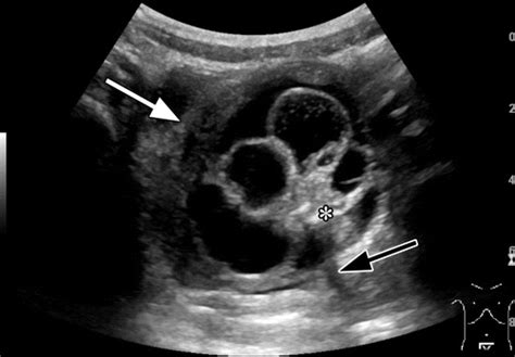 Ovarian Torsion Histology