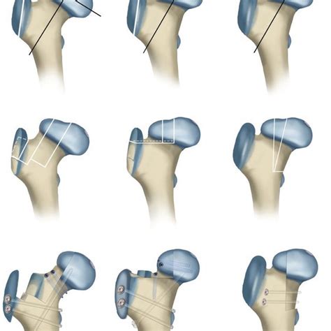 Pdf Femoral Head Ostectomy Following Osteotomy Of The | My XXX Hot Girl