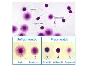 fragmentasi dna spermatozoa pemeriksaan  kualitas sperma