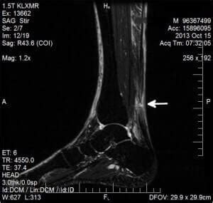 My Achilles Tendon Rupture MRI - Achilles Tendon Rupture