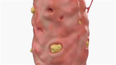 Palatine Tonsil With Tonsilloliths 3d Model By Esfey