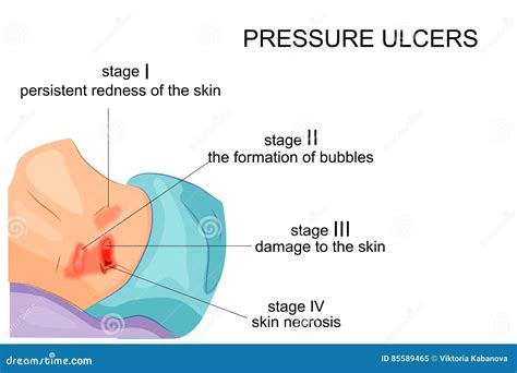 Stages Of Bedsores Stock Vector Illustration Of Problem 85589465