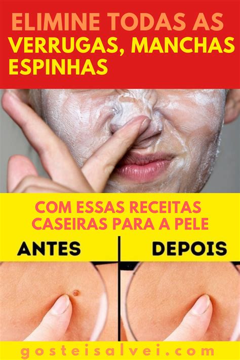 Elimine Todas As Verrugas Manchas E Espinhas Essas Receitas