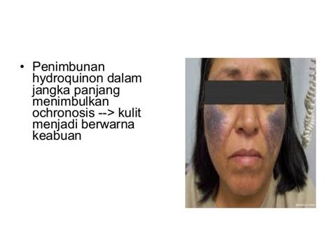 Kligman Formula Dalam Praktek Skin Care