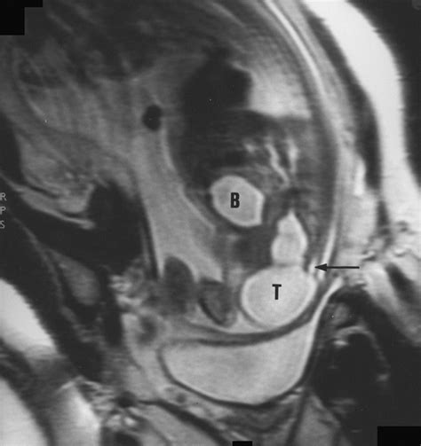 MR Imaging of Fetal Sacrococcygeal Teratoma Diagnosis and Assessment | AJR