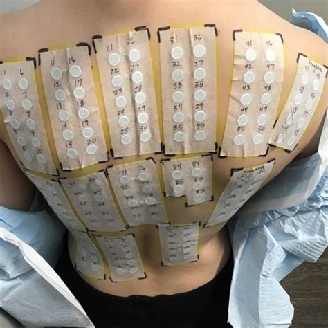 allergy patch testing dermatology specialists  spokane