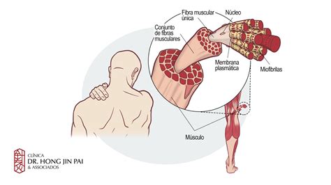 Pontos Gatilho Pontos de Tensão Muscular Clínica Dr Hong Jin Pai