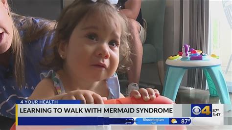 Girl With Mermaid Syndrome Learning To Walk Youtube