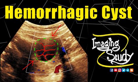 case  ovarian hemorrhagic cyst orads  ultrasound imaging study