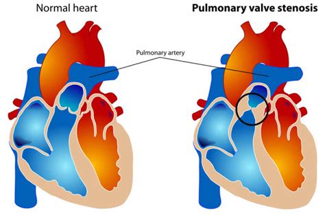 Pulmonary Valve Stenosis Causes Symptoms Diagnosis And Treatment