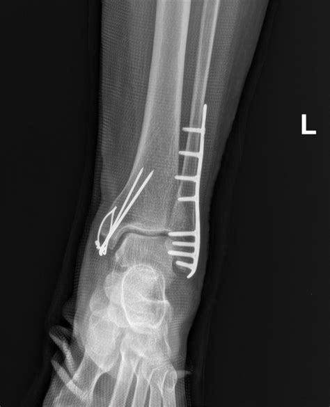 Broken Malleolus 43rd Day After The Surgery Doc Says The Infection Is