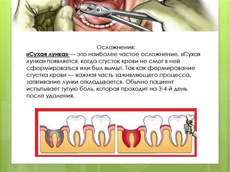 Этапы заживления лунки после удаления зуба - презентация онлайн