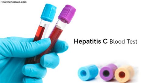 Hepatitis C Blood Test (Top 7 Things to Know about Hepatitis C Test)