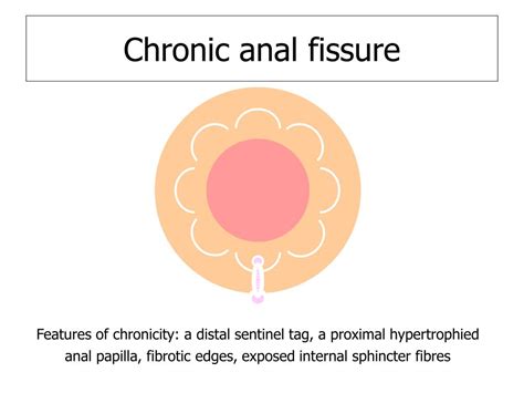 minor anorectal conditions powerpoint