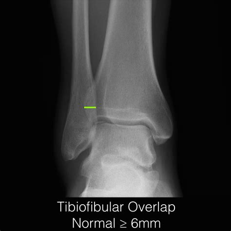 Osteochondral Fracture Of The Talar Dome Image Radiopaedia Org