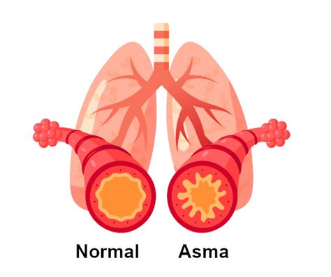 Asma Sintomas O Que Di Rio Gm