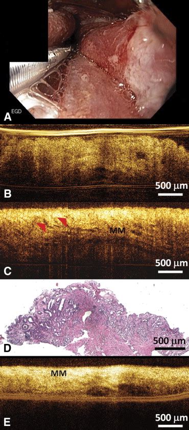 Structural Markers Observed With Endoscopic 3 Dimensional Optical