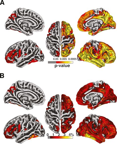 Cortical Thickness And CD4 Nadir A Whole Brain Vertex Wise Analysis