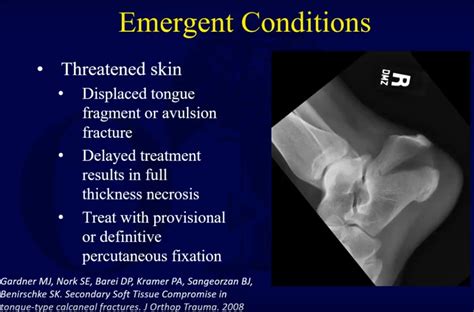 Calcaneal fracture: Emergency treatment — OrthopaedicPrinciples.com