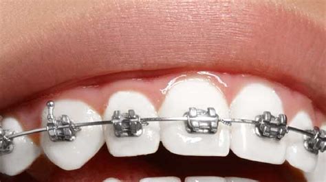 Why Do My Braces Give Me A Lisp At Jack Matteson Blog