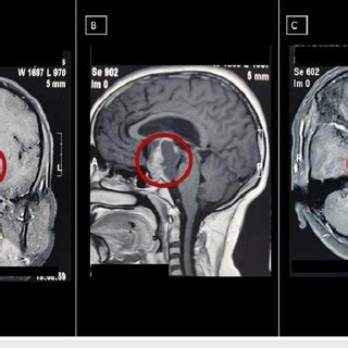 Preoperative contrast-enhanced MRI A: Preoperative contrast-enhanced ...