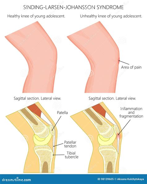 Adolescent Knee Pain_Osgood Schlatter Disease Cartoon Vector
