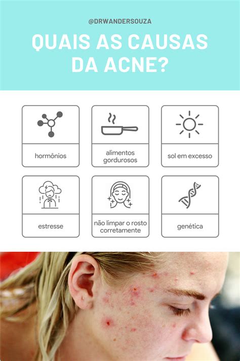 Quais As Causas Da Acne Acne Pele Acne Cravos E Espinhas