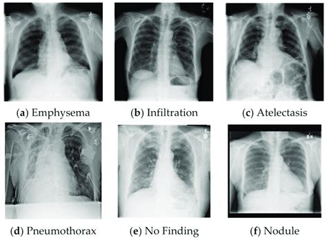 Six Examples Of The Chestx Ray14 Dataset Chestx Ray14 Consists Of Download Scientific Diagram