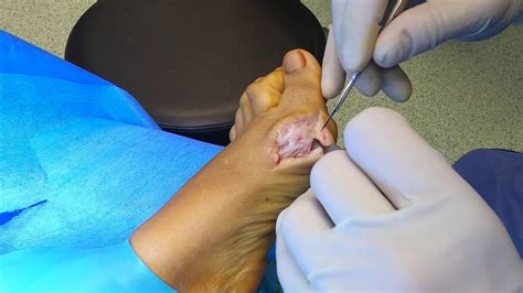 Operaci N De Hallux Valgus Juanete Youtube