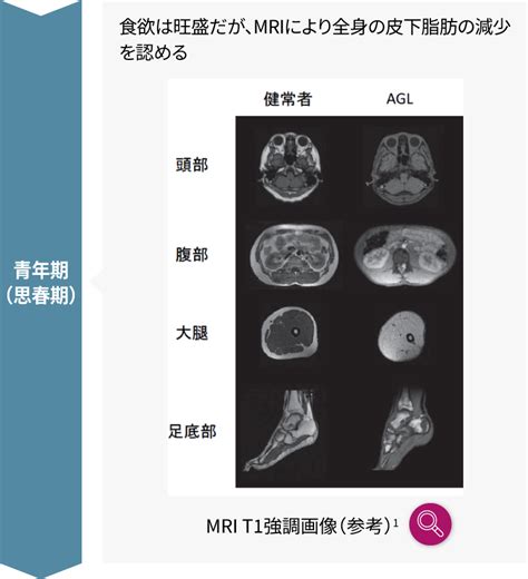 脂肪萎縮症 バーチャル症例検討会｜キエジ・ファーマ・ジャパン医療関係者向け製品情報サイト