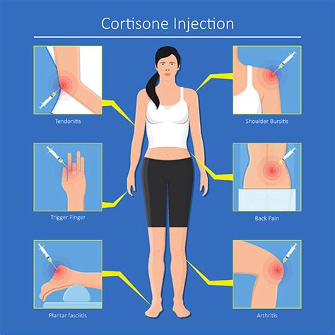 2 Things You Must Know About Corticosteroid Injections