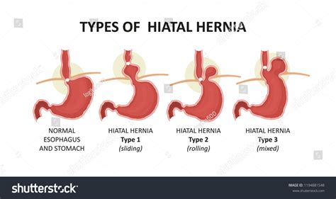 Hiatal Hernia Images Stock Photos Vectors Shutterstock