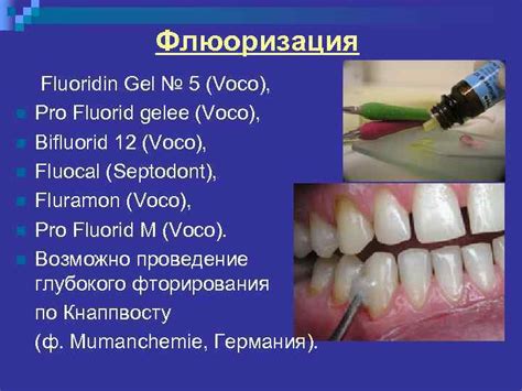 Фторирование зубов: все виды покрытия эмали фтором