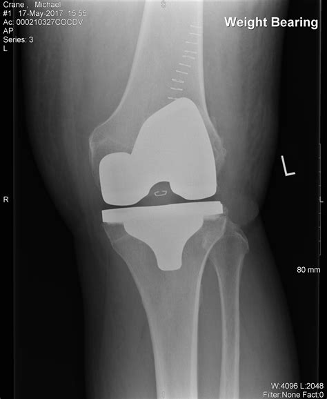 Knee Joint Operations – Knee and Hip Website
