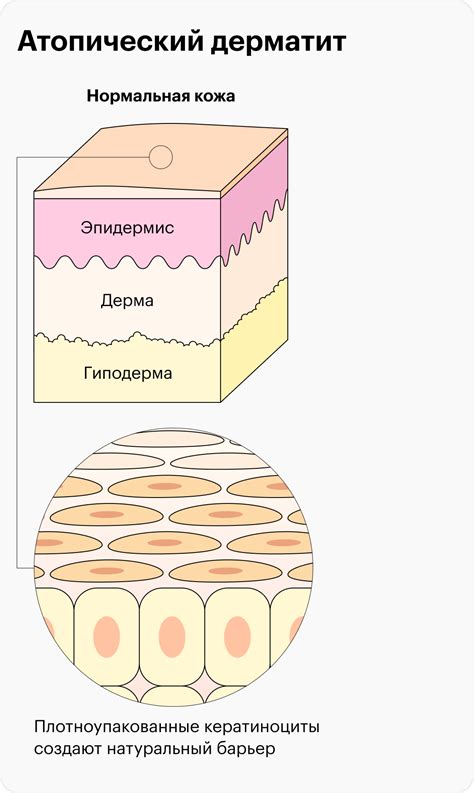 Частота мытья при атопическом дерматите: рекомендации | Блог мед ...
