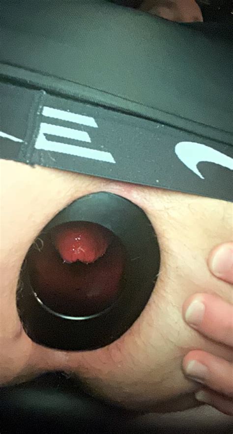 XXL MEO Anal Stretching Ring Pics XHamster