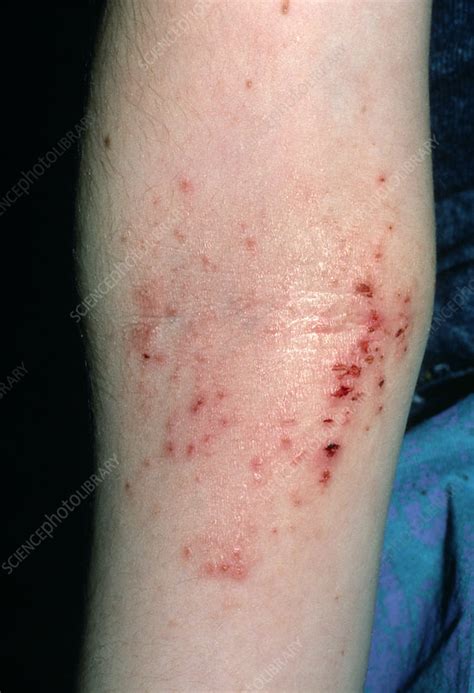 Eczema On Inside Elbows