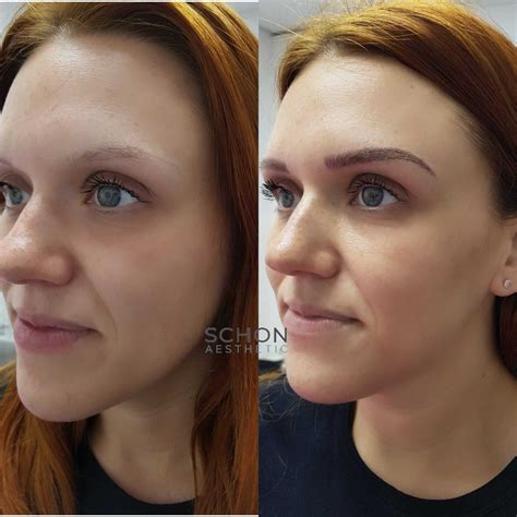 No1 Treatment For Russian Lips Birmingham Schon Aesthetic Ltd