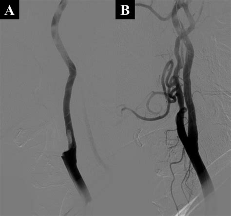 Endovascular Treatment Of Asymptomatic Free Floating Thrombus In The Carotid Artery Bifurcation