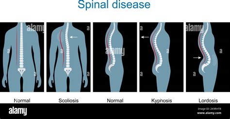 Patologie Della Colonna Vertebrale Tipi Di Difetti Della Colonna