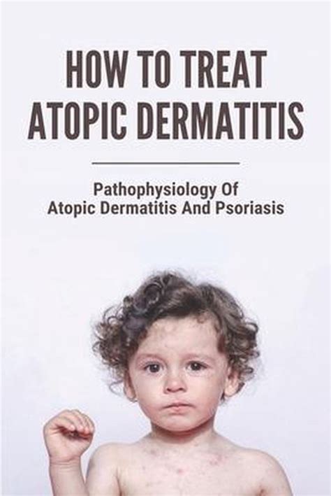 How To Treat Atopic Dermatitis Pathophysiology Of Atopic Dermatitis