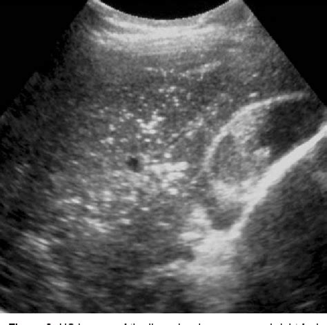 Figure From Hepatic Portal Venous Gas And Pneumatosis Intestinalis