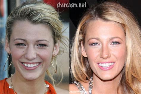 Blake Lively - Before and After Nose Job