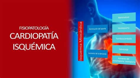 Fisiopatología Isquemia Miocardica Youtube