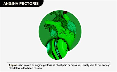 Angina Pectoris Types Occurrence Symptoms Diagnosis And Treatment