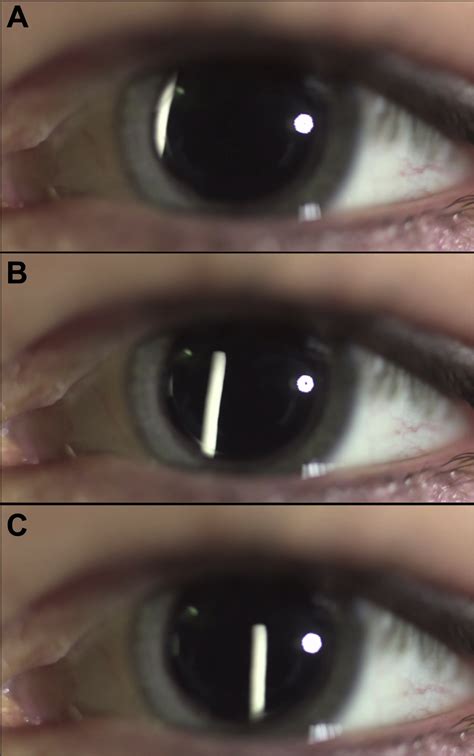 Free Floating Steroid Implant In Front Of The Anterior Hyaloid Face