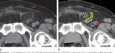 Inguinal Hernia Ct Scan