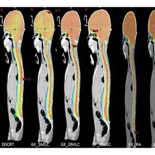 Dose Distribution From 3DCRT IMRT And RA Techniques Sagittal View