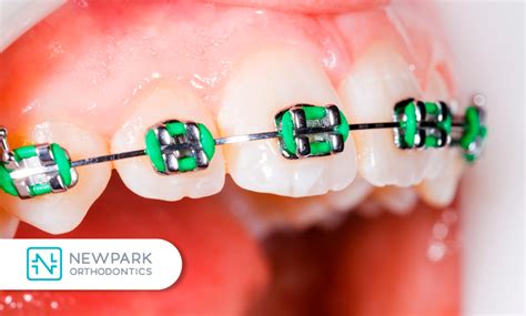 The History Of Dental Braces Newpark Orthodontics